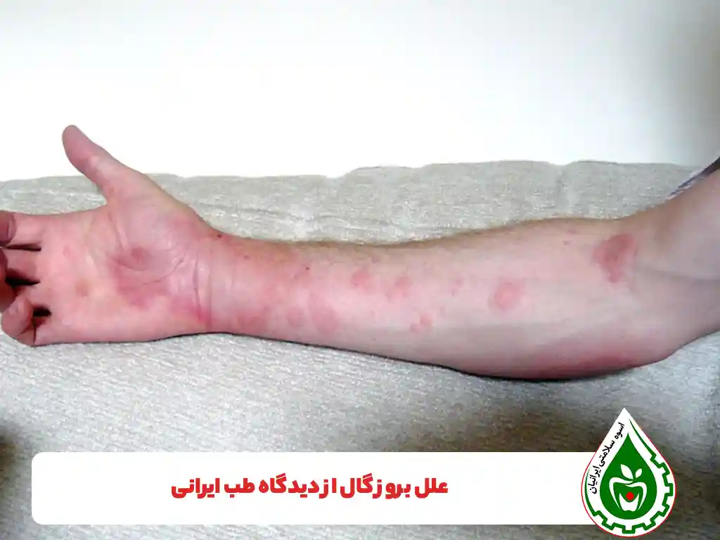 درمان سریع گال در طب سنتی - اسوه سلامت ایرانیان