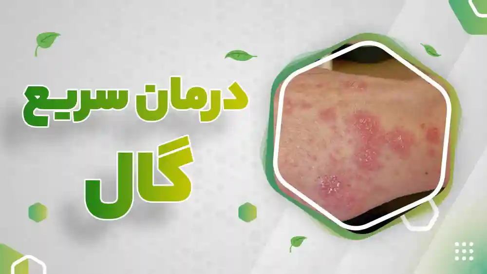 درمان سریع گال در طب سنتی - اسوه سلامت ایرانیان