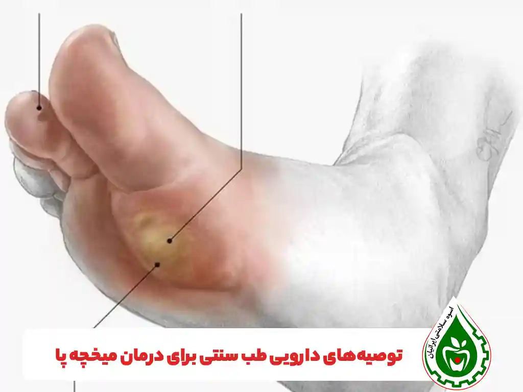 درمان فوری میخچه پا - اسوه سلامت ایرانیان