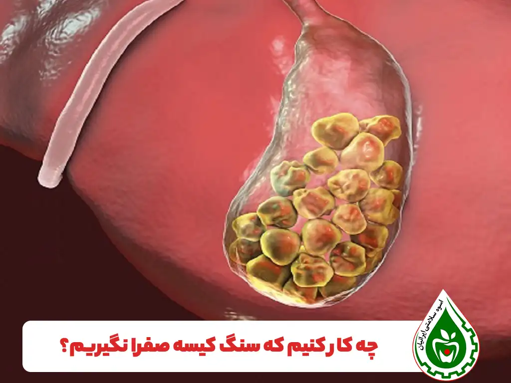 درمان سنگ کیسه صفرا