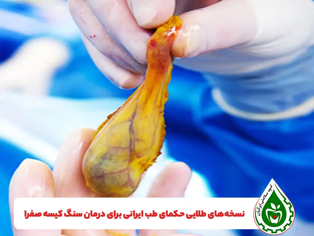 درمان سنگ کیسه صفرا