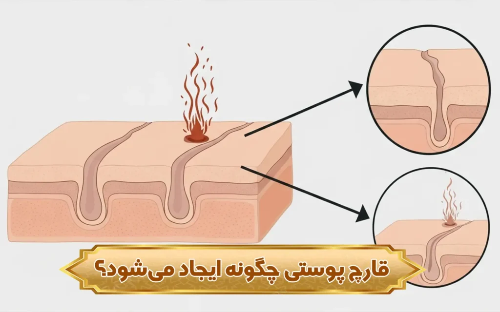 تصویر قارچ پوستی چگونه ایجاد میشود